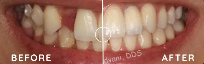 Before and after: collapsed bite, missing laterals, full-arch implant with porcelain finish