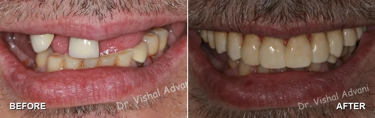 Before and after: missing upper teeth, all-on-5 dental implants