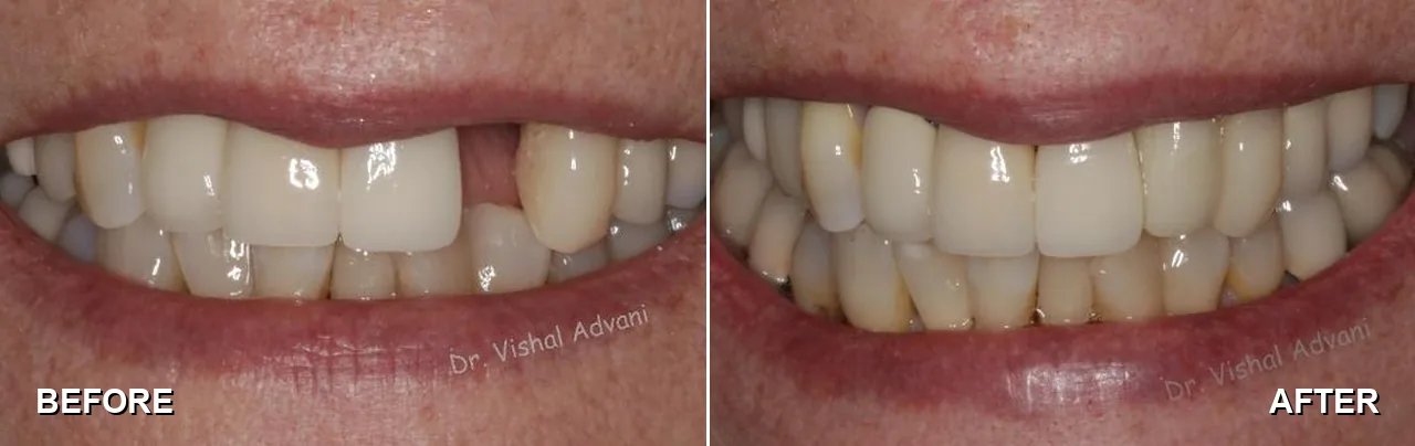 Before and after: broken front tooth, replaced with a dental implant