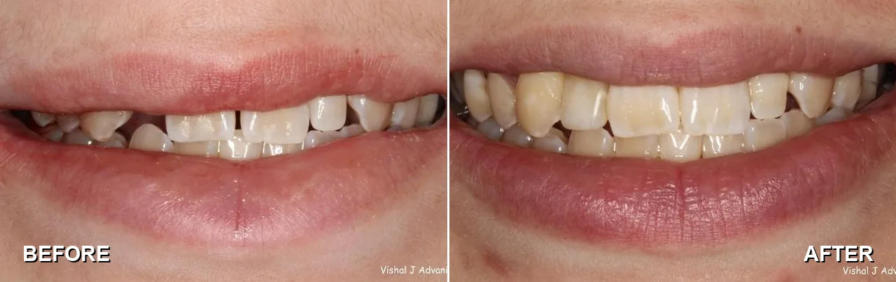 Before and after: missing adult tooth, replaced with a dental implant