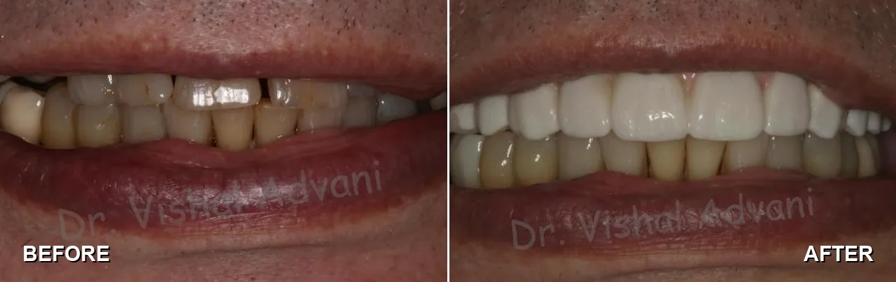 Before and after: before treatment, teeth-in-a-Day All-on-4® implants