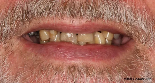 Before: All-Ceramic Bridge & Tooth-Colored Filling