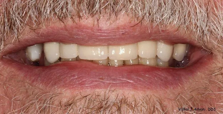 After: All-Ceramic Bridge & Tooth-Colored Filling