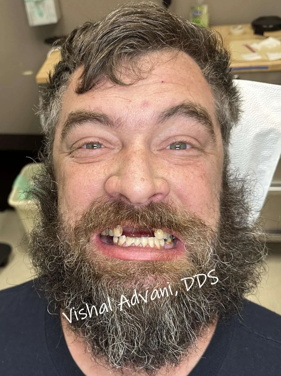 Before: All-on-4 Transformation