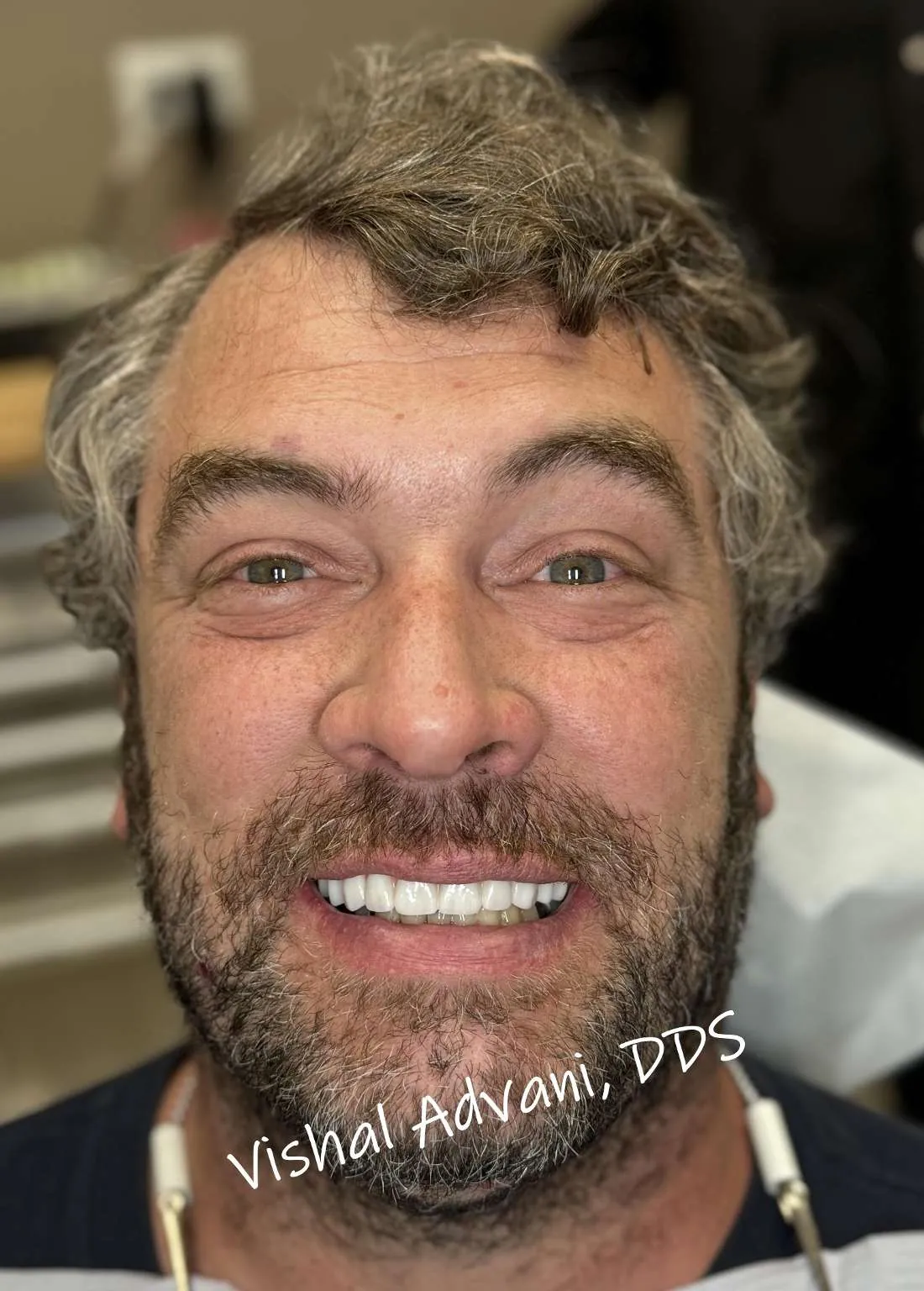 After: All-on-4 Transformation