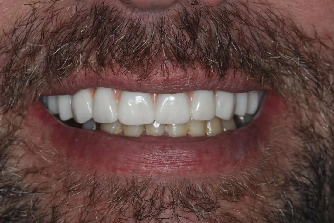 After: All-on-4 Transformation