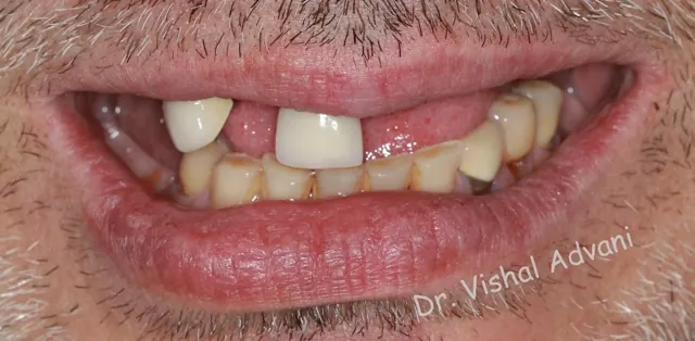 Before: All-on-5 for Missing Upper Teeth