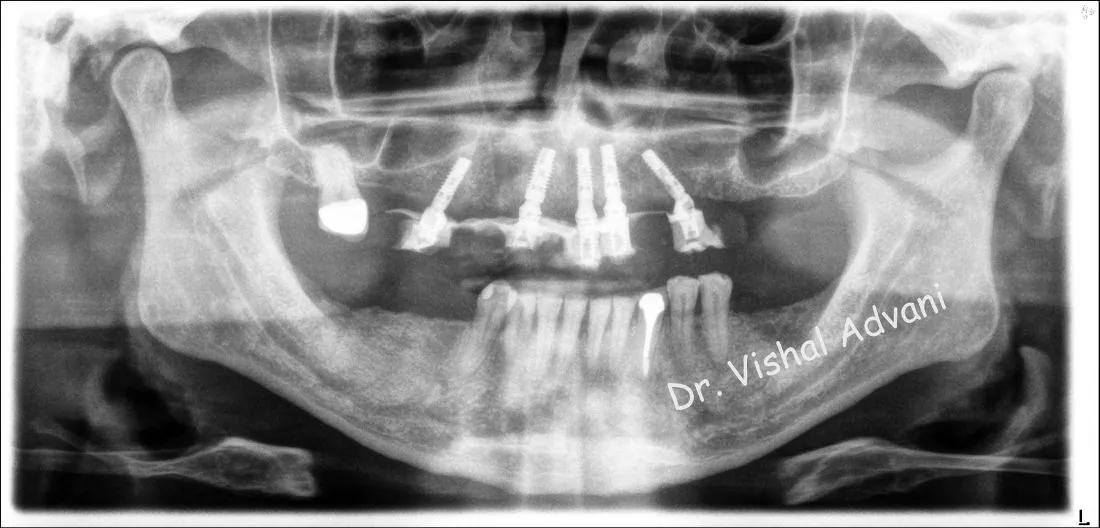 After: All-on-5 for Missing Upper Teeth