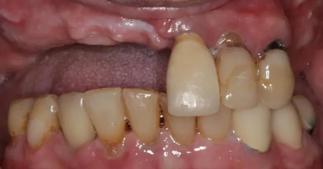 Before: All-on-5 Upper Implants