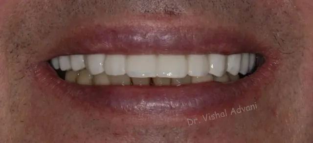 After: All-on-5 Upper Implants