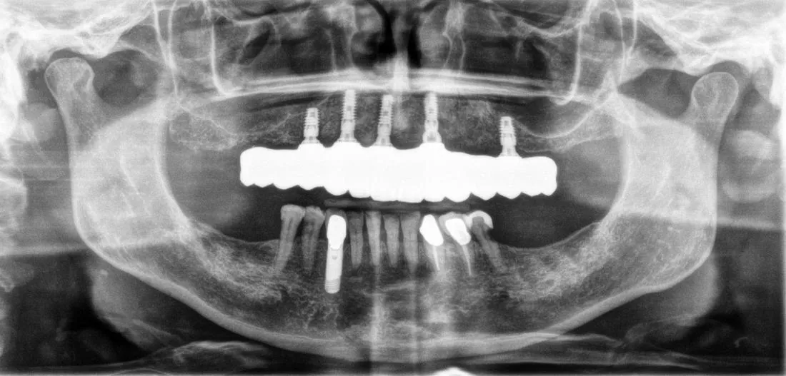 After: All-on-5 Upper Implants