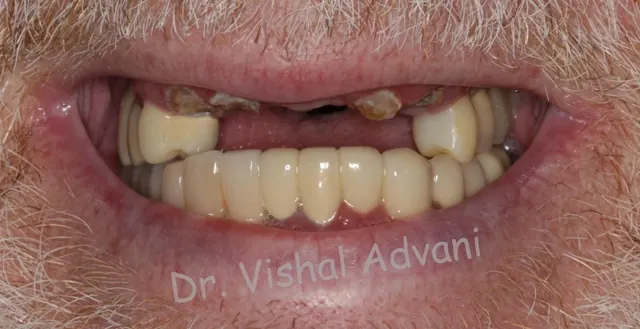 Before: Broken Front Teeth Replaced with Implants