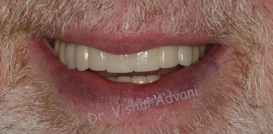 After: Broken Front Teeth Replaced with Implants