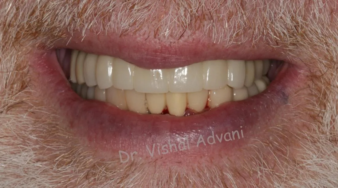 After: Broken Front Teeth Replaced with Implants