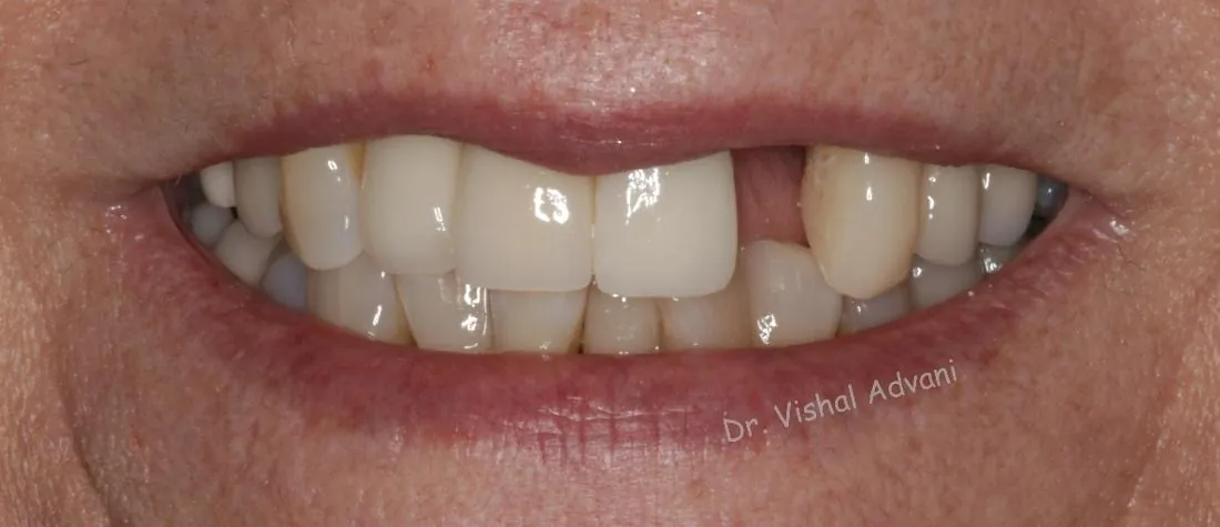 Before: Broken Front Tooth Replaced with an Implant