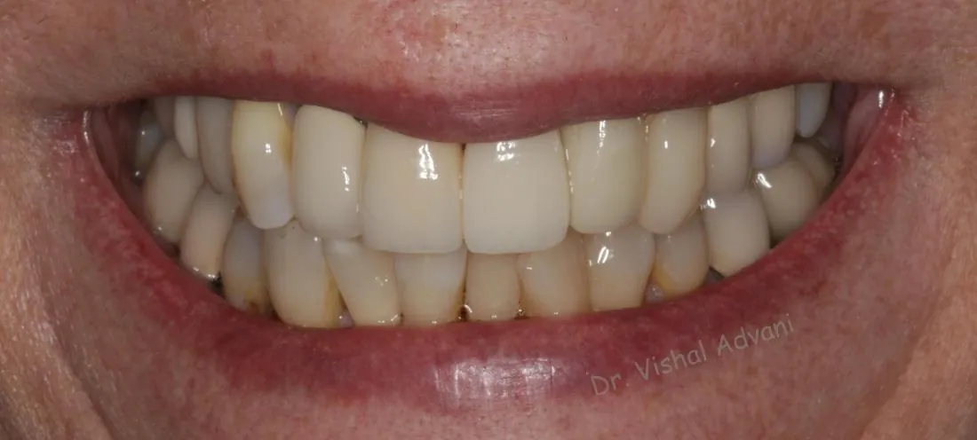 After: Broken Front Tooth Replaced with an Implant