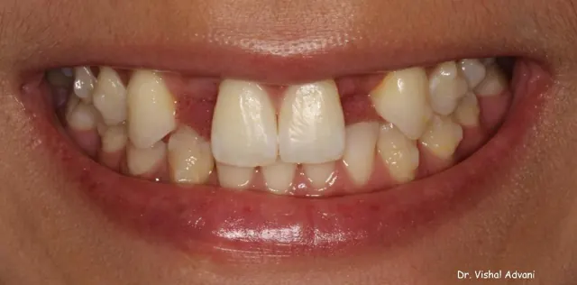 Before: Congenitally Missing Front Teeth