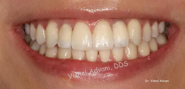 After: Congenitally Missing Front Teeth