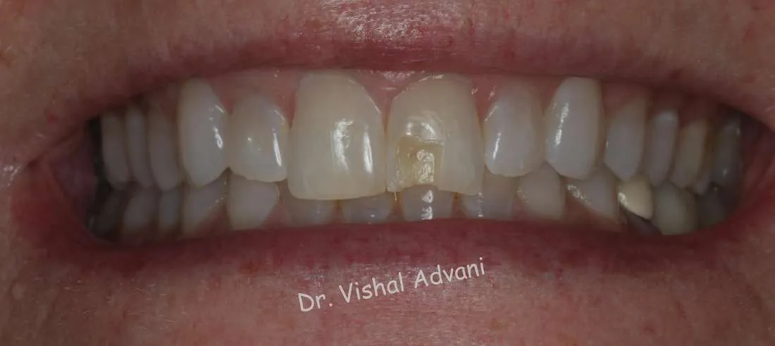 Before: Cosmetic Bonding for a Broken Tooth