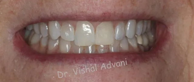 After: Cosmetic Bonding for a Broken Tooth