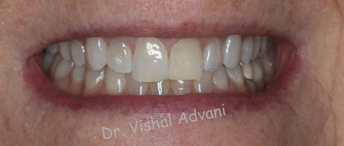 After: Cosmetic Bonding for a Broken Tooth