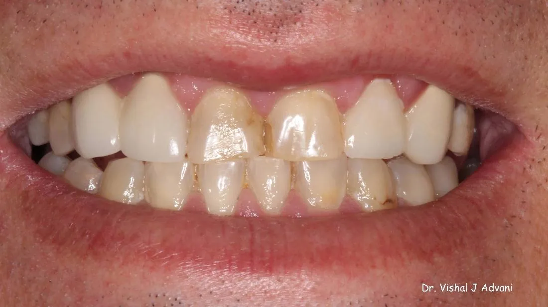 Before: Same-Day Crowns for Dark, Chipped Teeth