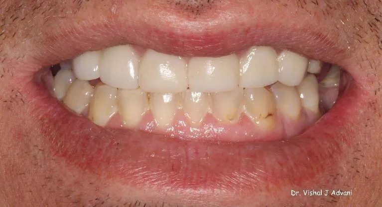 After: Same-Day Crowns for Dark, Chipped Teeth