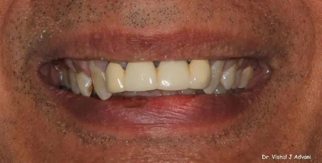 Before: Front Bridge & Veneers