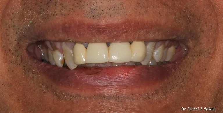 Before: Front Bridge & Veneers