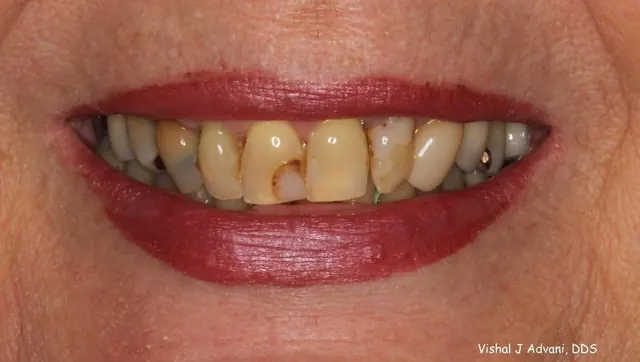 Before: Front Crowns to Improve Cosmetics