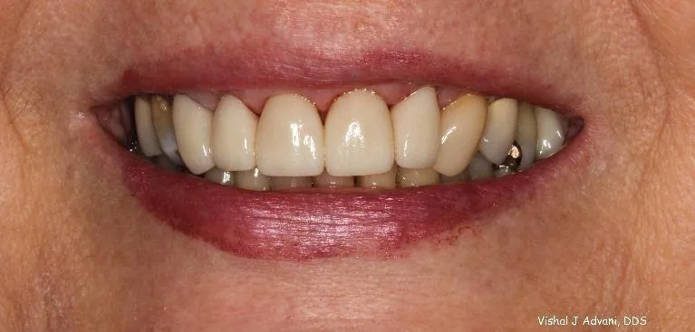 After: Front Crowns to Improve Cosmetics