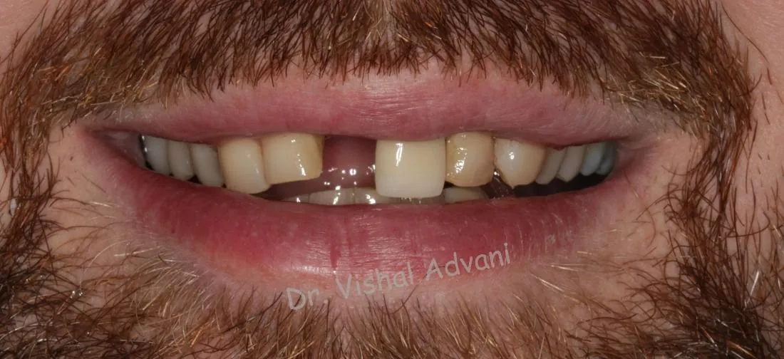 Before: Implant for a Broken Front Tooth