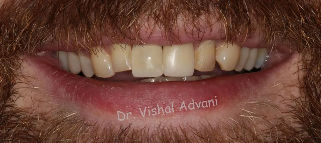 After: Implant for a Broken Front Tooth