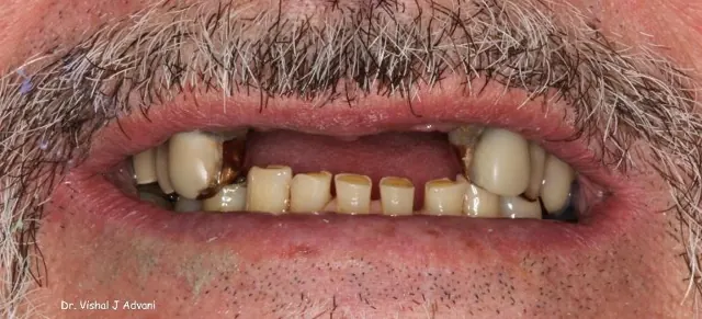 Before: Implants & Cosmetic Bridge