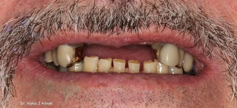 Before: Implants & Cosmetic Bridge