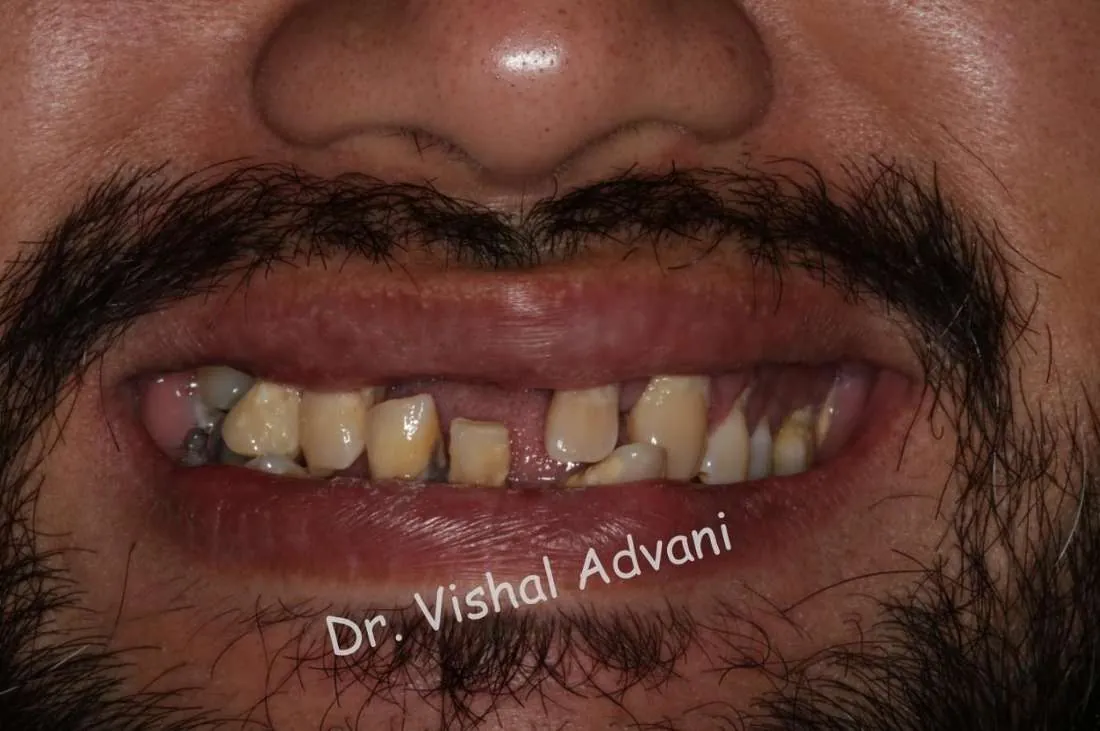 Before: Full-Mouth Transformation with Implants