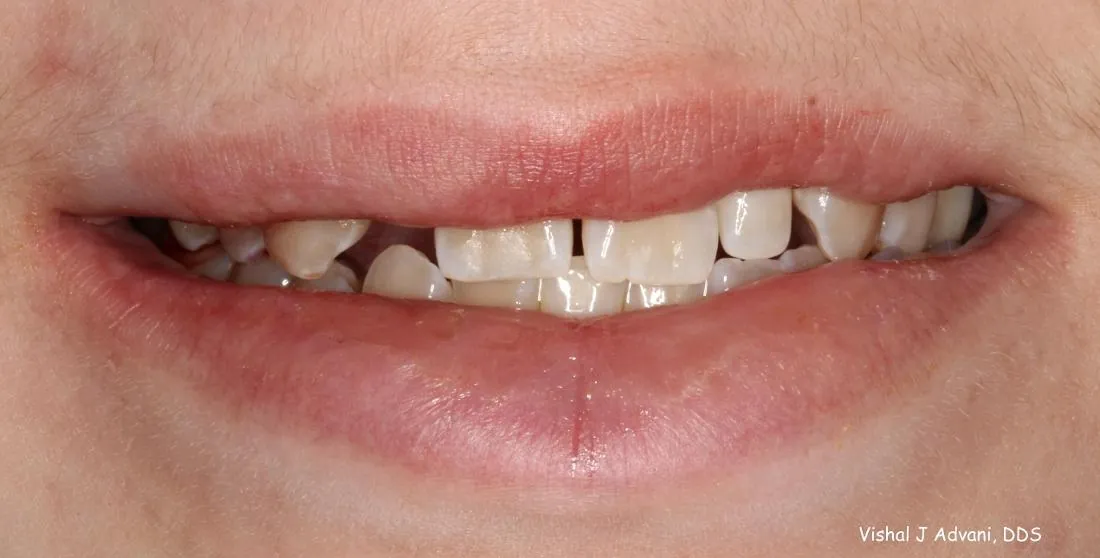Before: Missing Adult Tooth Replaced with an Implant