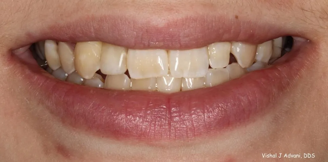 After: Missing Adult Tooth Replaced with an Implant