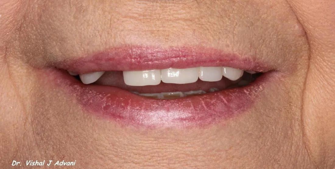 Before: Same-Day Extraction, Implant & Crown