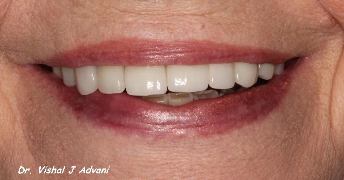 After: Same-Day Extraction, Implant & Crown