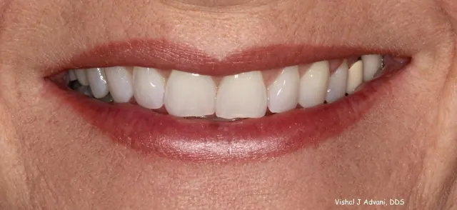 Before: Short-Term Orthodontics (4.5 Months)