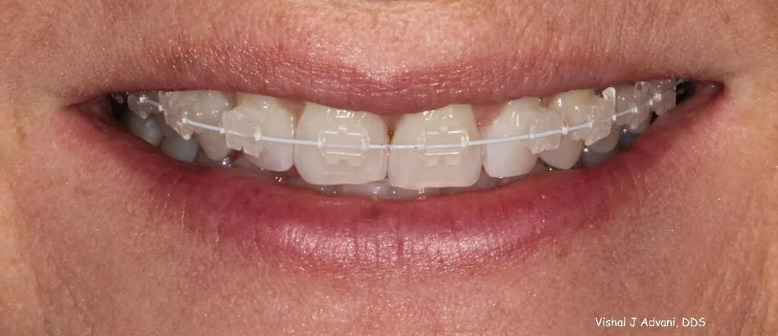 Before: Short-Term Orthodontics (4.5 Months)