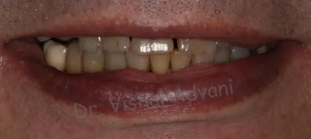 Before: Teeth-in-a-Day (All-on-4)
