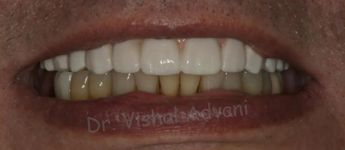 After: Teeth-in-a-Day (All-on-4)