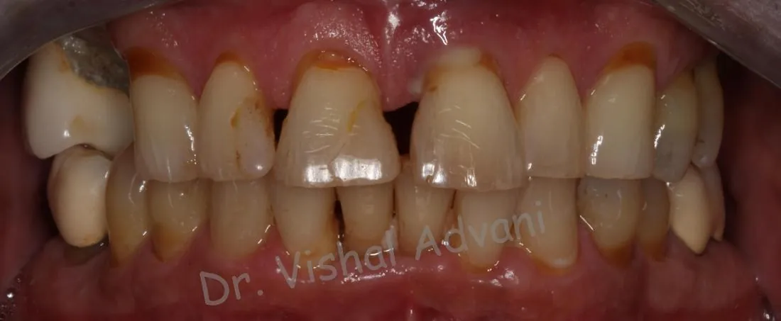 Before: Teeth-in-a-Day (All-on-4)
