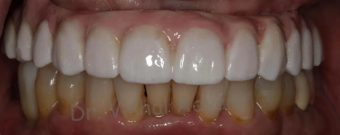 After: Teeth-in-a-Day (All-on-4)