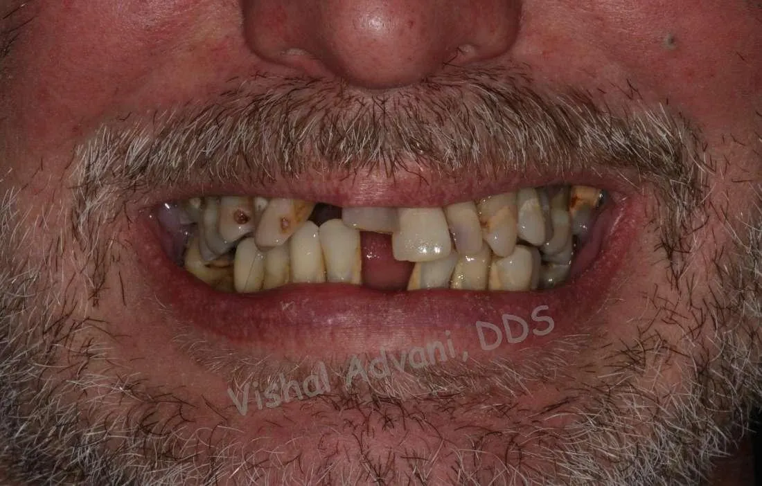 Before: Upper & Lower All-on-4