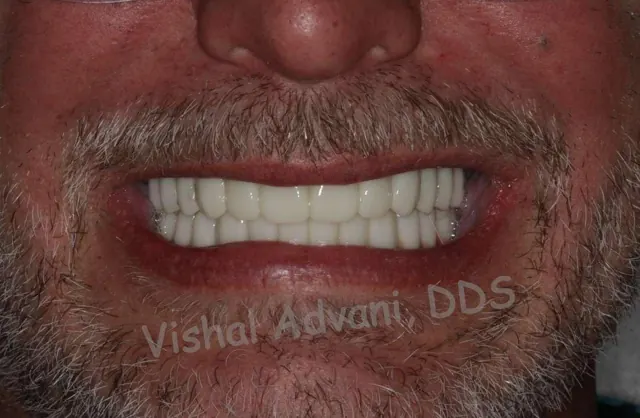 After: Upper & Lower All-on-4