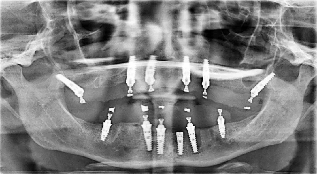 After: Upper & Lower All-on-X Bridges