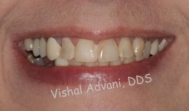 Before: Upper & Lower All-on-X Bridges